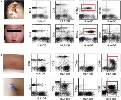 Cytologic Analysis of Epstein-Barr Virus-Associated T/Natural Killer-Cell Lymphoproliferative Diseases